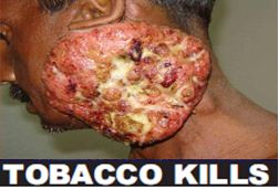 India 2011 Health Effects Other (Smokeless Tobacco Products) - diseased organ, gross